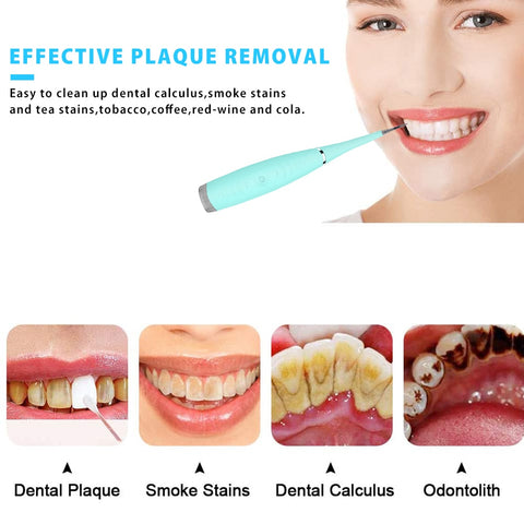 Image of Ultrasonic Tooth Cleaner Whiten Hygiene